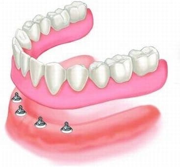 Ошибки при протезировании зубов