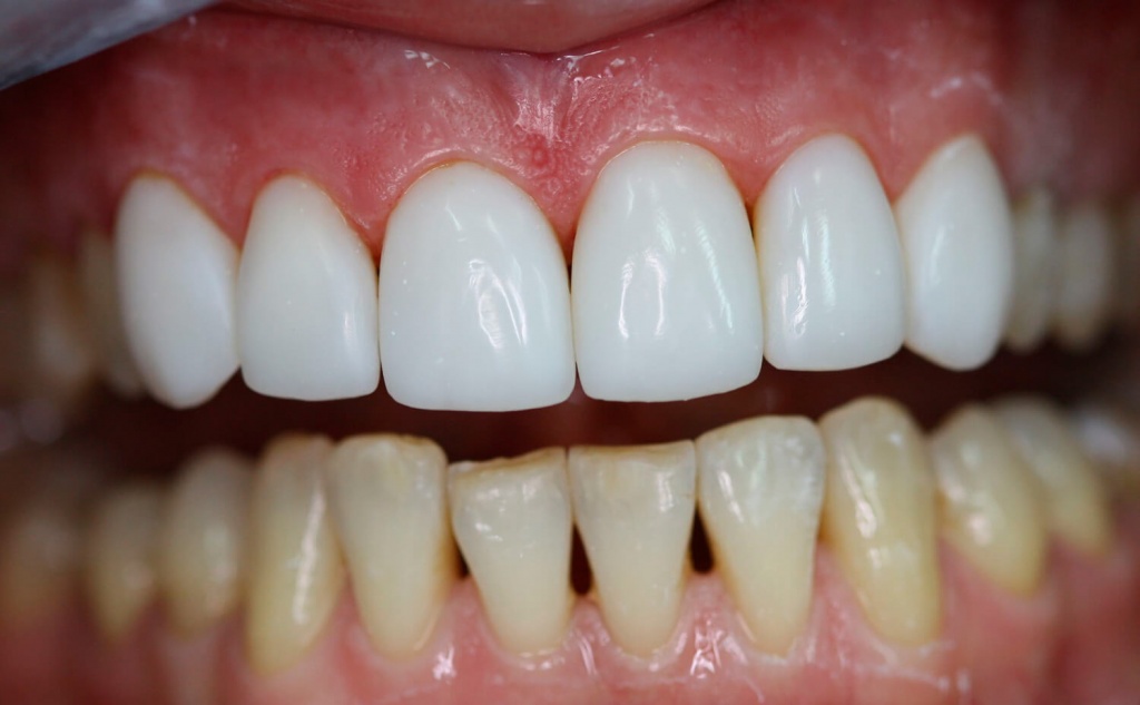 Протезирование зубов: что такое виниры