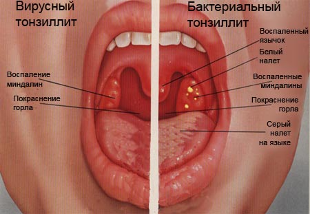 Симптомы воспаления миндалин